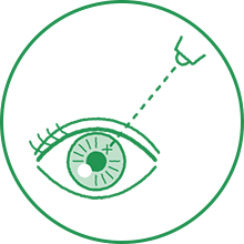 レーザー治療のイメージ図