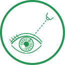 レーザー治療のイメージ図